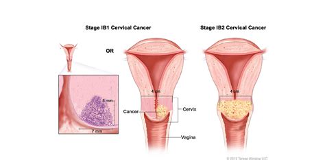 Sebagian besar tubuh wanita mampu melawan infeksi hpv. Kanker Serviks - Adi Husada Cancer Center (AHCC)