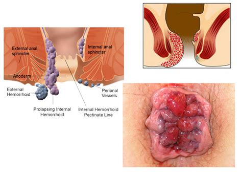 Most common signs or symptoms that both rectal cancer and hemorrhoids are bleeding from the rectum, more gas, stool size, and diarrhea. Pushing external hemorrhoids into anus - Top Porn Images