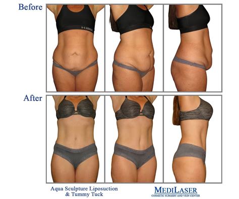 I know when i'm recommending zo products to my clients i'm not second guessing. BEST-COSMETIC-SURGEON-NEAR-ME-FRISCO-TEXAWS-TUMMY-TUCK ...