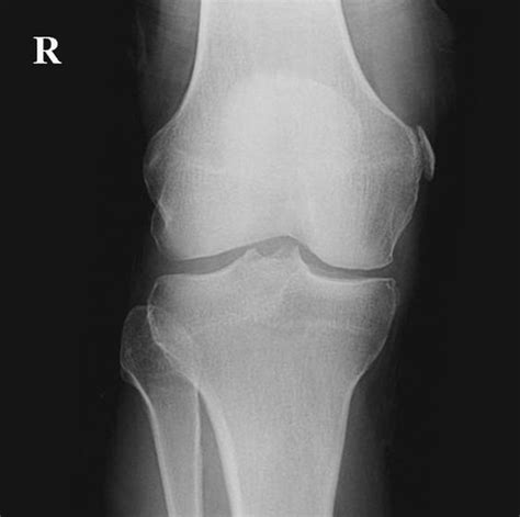 It is a common incidental finding on knee radiographs. Pellegrini-Stieda (PS) lesions are ossified post-traumatic ...