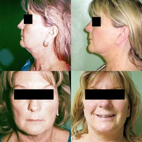 It is intended for use by residents of the united states. Facelift & Neck Lift (Rhytidectomy) Roanoke, VA