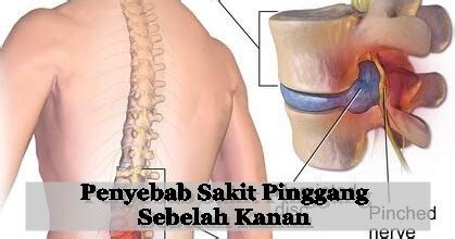 Dalam pembahasan mengenai kondisi sakit pada kaki sebelah kanan yang dapat terjadi pada ibu hamil, penjelasan penyebab hal tersebut terjadi perlu dipahami terlebih dahulu. Obat Sakit Pinggang Sebelah Kanan Secara Alami | QnC Jelly ...