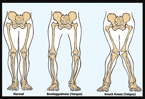 .melihat, atau bahkan merasakan sendiri bentuk 'kaki x' atau 'kaki o'. Dua orang siswa memilik bentuk tulang kaki yang menyerupai ...