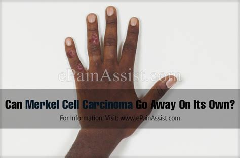 There are more than 150 types of this virus. Can Merkel Cell Carcinoma Go Away On Its Own & What Are It ...