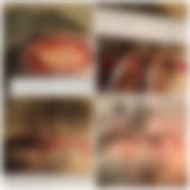 Scalp Flap Skin Graft Alternative Cases | BCC Wound ...