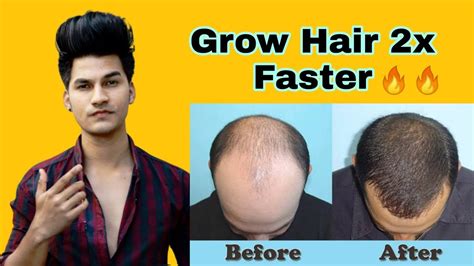 1 × 20ml hair growth oil. Grow Your Hair 2x Fast |Best hair growth oil in india |100 ...