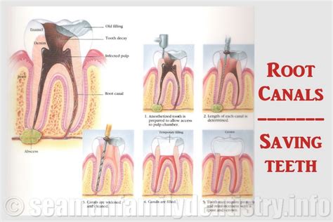 But having a root canal procedure will cost more than filling. Root Canals (Endodontic Treatment)