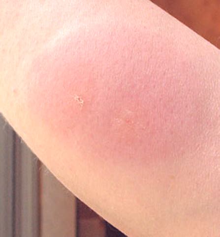 Find out more about skeeter syndrome and mosquito bite reactions. Mosquito bites pictures If you are interested in more ...