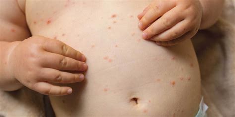 Jenis cleanser serta manfaatnya yang disesuaikan dengan jenis kulit (foto: 5 Jenis Penyakit Kulit Pada Bayi dan Cara Mengatasinya