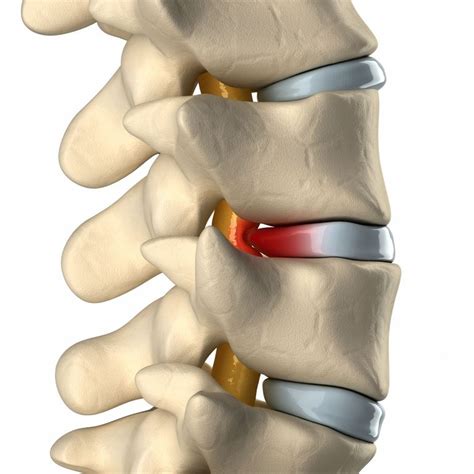 Le canal lombaire étroit se manifeste cliniquement par: Le canal lombaire rétréci ou étroit | Santé Orthopédique