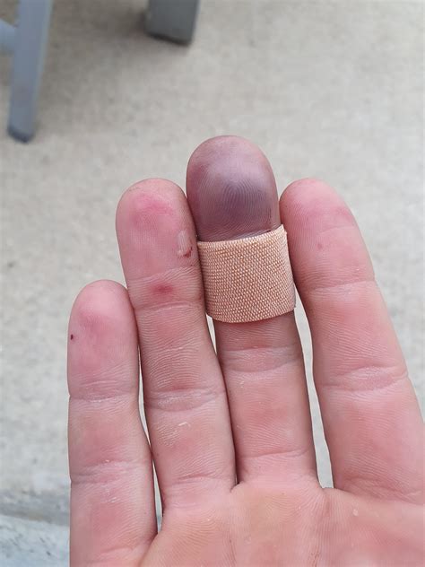 Crushed Finger : DiagnoseMe