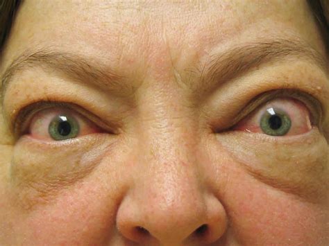 Common signs and symptoms of graves' disease include: Graves Disease - Causes, Signs, Symptoms, Medication ...