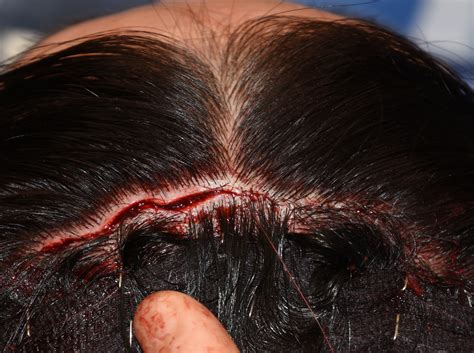 Aside from being considerably cheaper than electrolysis, it can also treat large areas at once. Minimizing the Appearance of Scalp Scars in Aesthetic ...