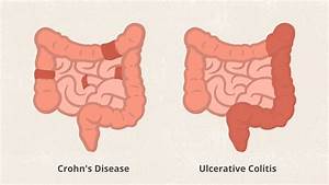 3 Key Difference Between Crohn 39 S Disease And Ulcerative Colitis