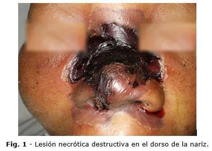 Mucormycosis by santosh narayankar 20532 views. Mucormicosis rinocerebral | Soares | Revista Cubana de ...