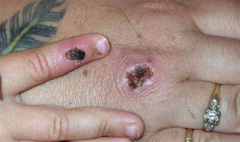 The first case caught the virus abroad before passing it onto someone in the same house. Monkeypox UK outbreak: Where has Monkeypox spread to in ...