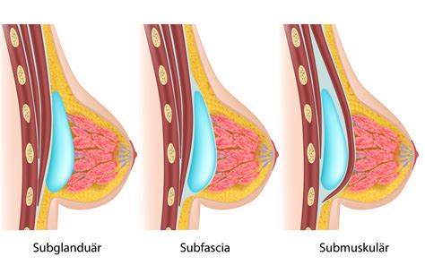 Guten tag, mein name ist dr. BrustvergrÃ¶ÃŸerung KÃ¶ln | Brust OP | Komplett SubmuskulÃ ...