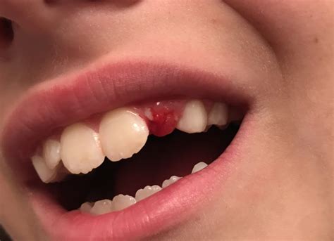 This provides a more sanitary. It's Time For That Baby Tooth To Go! | Charlotte Smiled