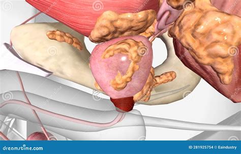 Le Cancer De La Prostate En Phase Iv Illustration Stock - Illustration ...