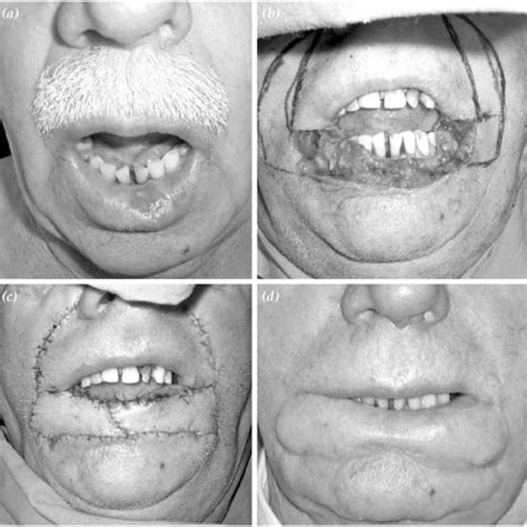 Br j plast surg 33:340. Left angular artery based Fujimori gate flap; (a ...