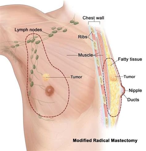 In 2020, an estimated 2,620 men will be diagnosed with breast cancer this year in the u.s. Breast Cancer — Steemit