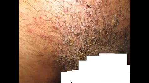 As long as it doesn't become infected, an ingrown. Pubic Hair Folliculitis + Impetigo - YouTube