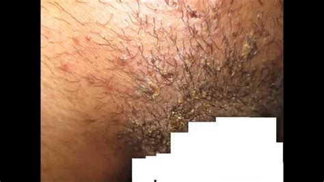 You can even shave while you're in the shower. Pubic Hair Folliculitis + Impetigo - YouTube