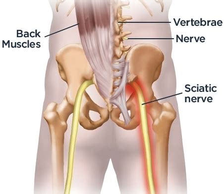 It causes sharp pain in the back while sitting on a chair or sofa. Treating Sciatic Pain with Yoga - Sciatica Symptoms and ...