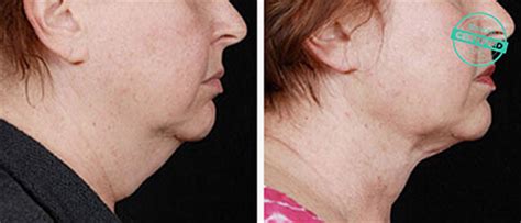 Eine liposuktion reduziert die anzahl dieser zellen aber für immer und schärft so die körperform. Vorher und Nachher - Fettabsaugung | Brandeis Clinic