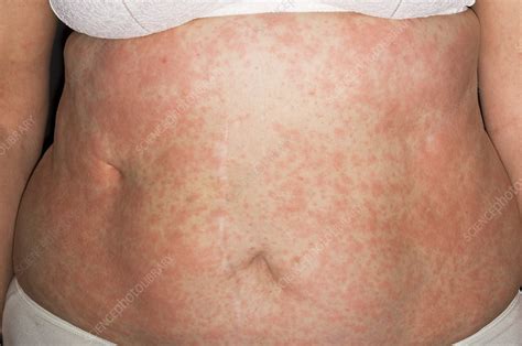 Urushiol triggers an allergic reaction when it comes into contact with skin, resulting in an itchy rash, which can appear within hours of exposure or up to several days later. Urticaria rash - Stock Image - M280/0267 - Science Photo ...