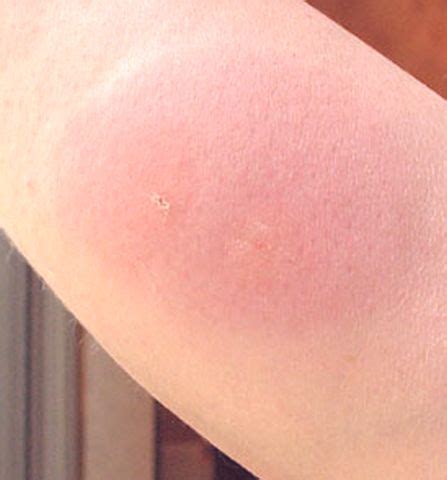 Fire ants fire ants are aggressive stinging ants found most commonly in the southern united states. 77 best images about Skeeter Syndrome Pictures on ...