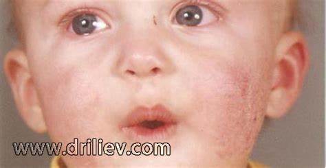 Диета при атоп дерматит Диета, храни и лечение при атопичен дерматит | Дерматологичен център Диета, храни и лечение при атопичен дерматит | Дерматологичен център Диета при атоп дерматит