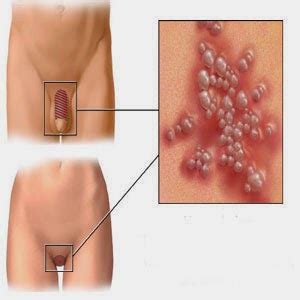 Can an ingrown hair on penis bleed during sex? genital_warts_images.jpg | Difference Between | genital ...