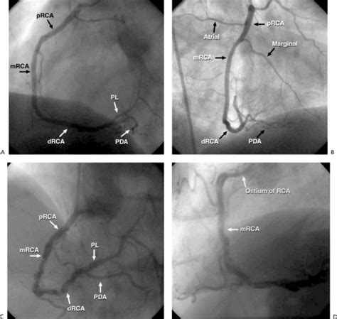 The international nomenclature (terminologia anatomica) of right and left branches of the coronary arteries: Coronary Angiography | Thoracic Key