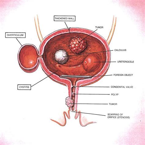 Blood in the urine (hematuria) is often the most common sign of bladder cancer. Bladder Cancer - Durward Black, MD