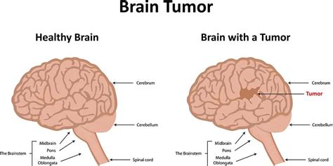 Learn more from webmd about what causes them and what puts a child at risk. 14 Warning Signs and Symptoms of Brain Tumor
