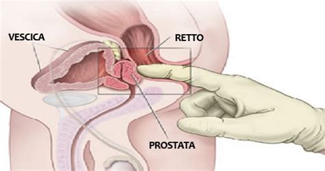 In caso di prostata ingrossata è consigliato ridurre il consumo di carni rosse, eliminare l'utilizzo di sale e il consumo di caffè e cioccolato. Prostata Ingrossata: Cause e Rimedi