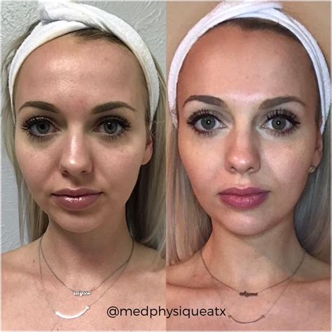 Before and After - Austin, TX: Med Physique Center For Aesthetics