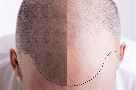 Maybe you would like to learn more about one of these? How Long Does Scalp Micropigmentation Last on Average ...