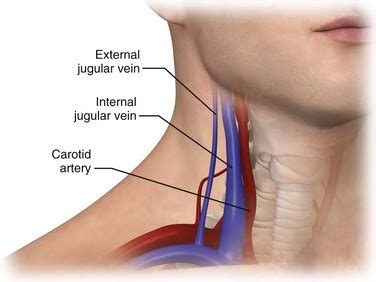 The carotid arteries run along either side of your neck. Flow Evaluation of the Internal Jugular Vein after Neck ...