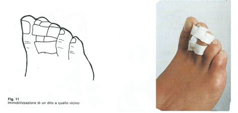 il bendaggio dell'alluce