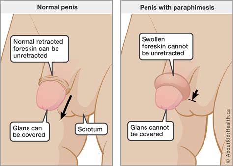 Get a lover that turns you on and enjoy life. How to give head to uncircumsized penis.