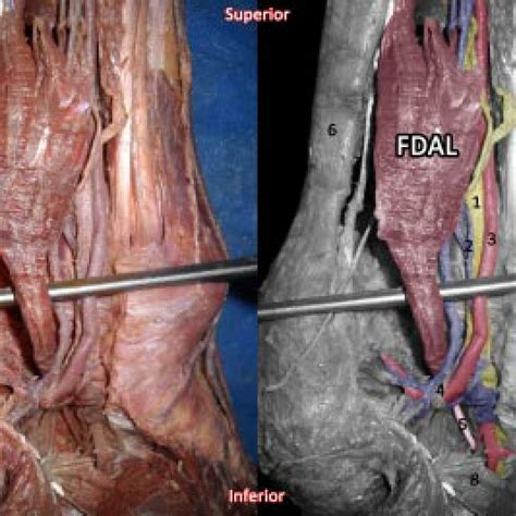 The flexor tendon connects to the flexor muscles above the knee, serving a crucial role in the movement that pulls the leg and hoof up under the body. Left Leg Flexor Tendon Location - Psoas - a lot has been ...