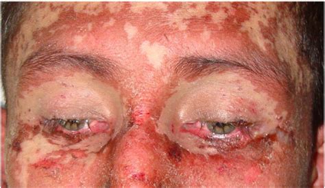 This is a very serious, rare condition where the mucous membranes. Stevens-Johnson syndrome - MedweiSer Health