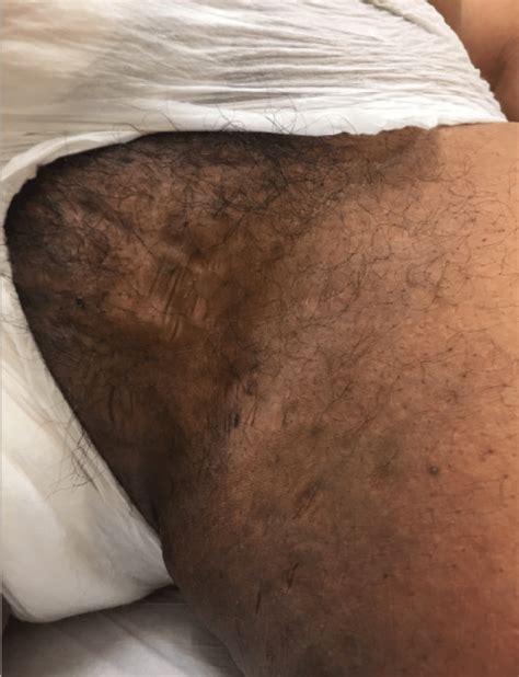 Boils groin area.toms, causes, treatment it is very common to get boils groin. Hidradenitis suppurativa manifesting as hyperpigmented ...