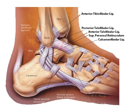 Has anyone else suffered from this? Ankle lateral ligament injury : causes , symptoms ...