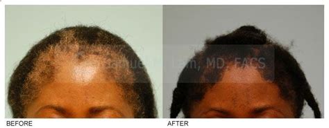 Hair loss in the African community is very common in both ...