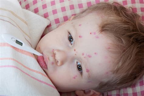 Infeksi yang disebabkan oleh virus varicella zoster ini bisa menyebabkan munculnya bintik merah berair pada kulit bayi. Ветрянка у ребенка: Симптомы и лечение - Здоровье ребенка ...