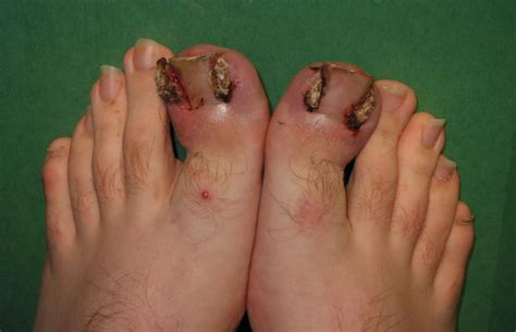 Stubbing the toe can result in several different injuries Infected foot: Symptoms, types, risk factors, and treatments