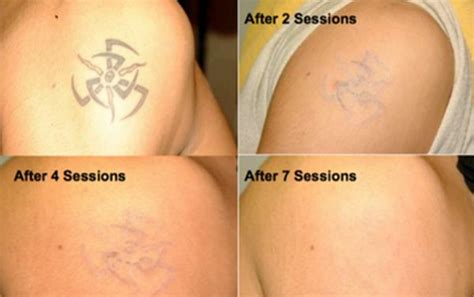 Be sure your artist covers your new tattoo in a thin layer of petroleum jelly and a bandage. Tattoo Temoval Before And After Pictures | Tattoo removal ...